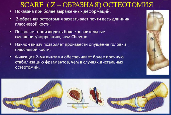 Метатарзалгия стопы. Что это такое, симптомы, лечение