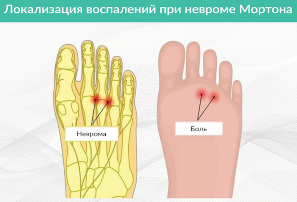 Метатарзалгия стопы. Что это такое, симптомы, лечение