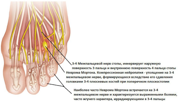 Метатарзалгия стопы. Что это такое, симптомы, лечение