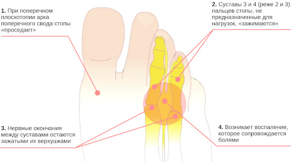 Метатарзалгия стопы. Что это такое, симптомы, лечение