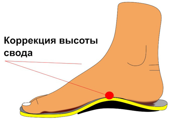 Метатарзалгия стопы. Что это такое, симптомы, лечение