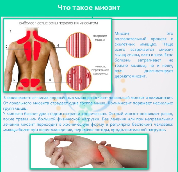 Миозит мышц спины, воспаление. Симптомы и лечение, мази