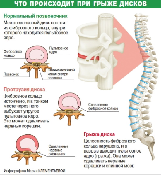 Проверка позвоночника на грыжу и остеохондроз. Обследование, МРТ, КТ-диагностика