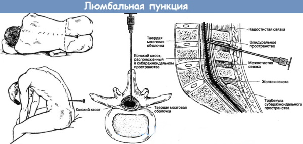 Пункция спинного мозга (люмбальная) позвоночника. Показания