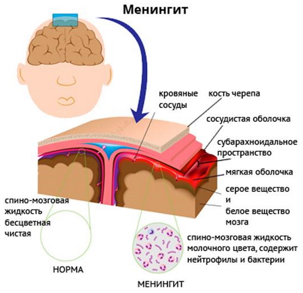 Пункция спинного мозга (люмбальная) позвоночника. Показания