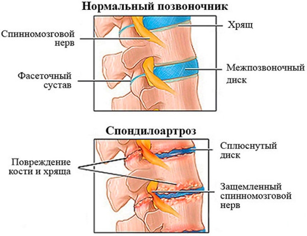 Сакрализация l5 позвонка в поясничном отделе. Что это такое, лечение