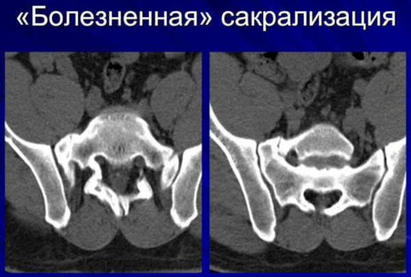 Сакрализация l5 позвонка в поясничном отделе. Что это такое, лечение