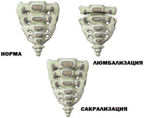 Сакрализация l5 позвонка в поясничном отделе. Что это такое, лечение