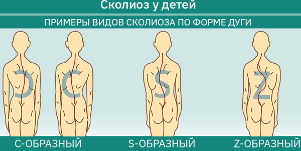 Сколиоз 2 степени. Фото, лечение позвоночника, s-образный