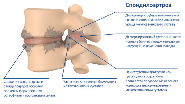 Спондилоартроз пояснично-крестцового отдела позвоночника. Лечение, что это, симптомы