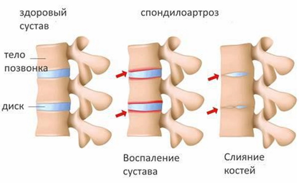 Спондилоартроз пояснично-крестцового отдела позвоночника. Лечение, что это, симптомы