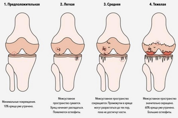 Субхондральный склероз суставных поверхностей. Что это такое