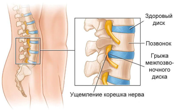 Травмы позвоночника. Первая помощь, классификация, симптомы