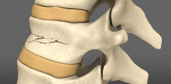 Трещина в позвоночнике. Симптомы, лечение, сколько заживает