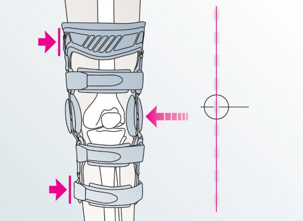 Тутор коленного сустава (ортез). Цены, как правильно одевать