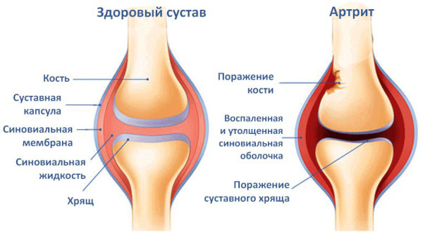 Тутор коленного сустава (ортез). Цены, как правильно одевать