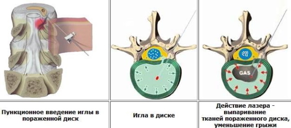 Вертебрология что это такое. Вертеброневролог что лечит