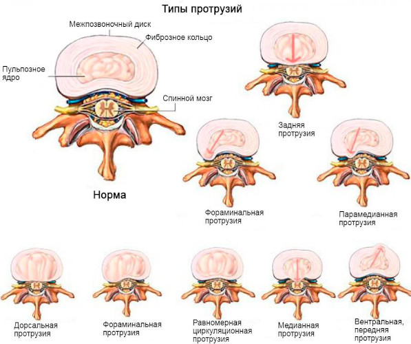 Виды грыж живота, позвоночника, межпозвоночных, паховых