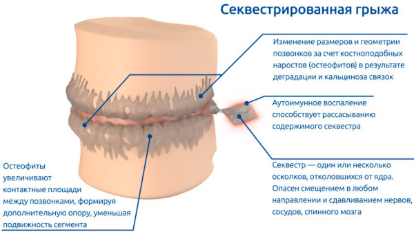 Виды грыж живота, позвоночника, межпозвоночных, паховых