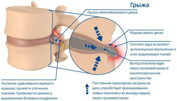 Виды грыж живота, позвоночника, межпозвоночных, паховых