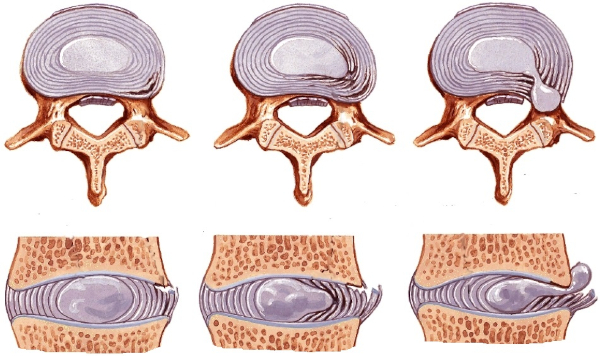 Виды грыж живота, позвоночника, межпозвоночных, паховых