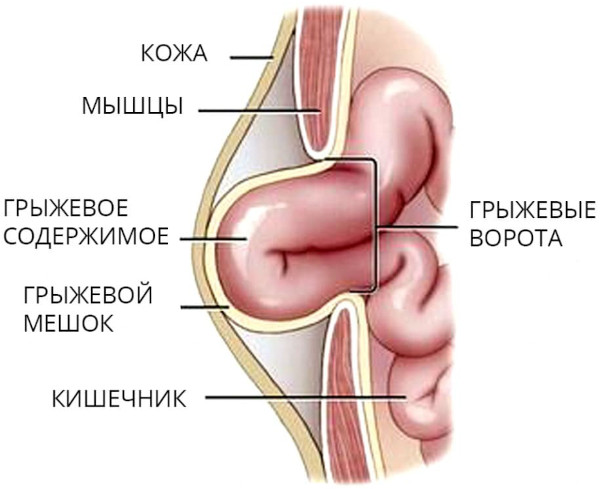 Виды грыж живота, позвоночника, межпозвоночных, паховых