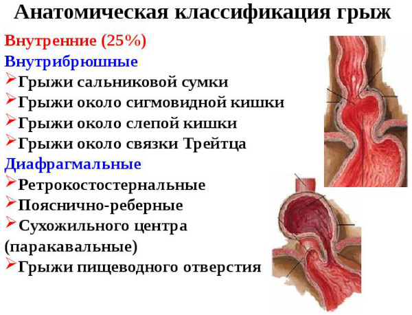 Виды грыж живота, позвоночника, межпозвоночных, паховых