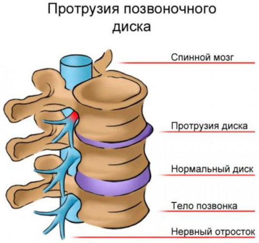 Виды грыж живота, позвоночника, межпозвоночных, паховых