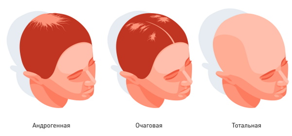 Женские гормоны у мужчины. Признаки, норма, причины и лечение