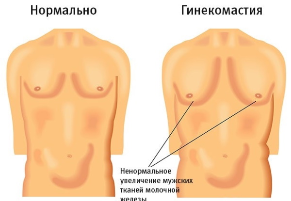 Женские гормоны у мужчины. Признаки, норма, причины и лечение