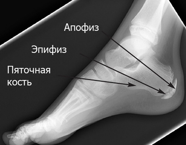 Апофизит пяточной кости у ребенка, болят пятки: что это, лечение