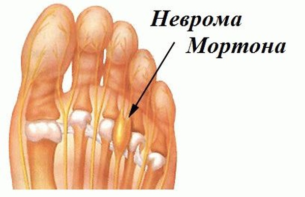 Апофизит пяточной кости у ребенка, болят пятки: что это, лечение