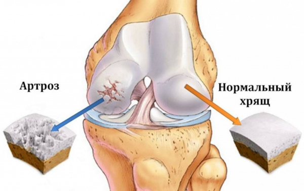 Артроз и остеоартроз. Чем отличается, разница