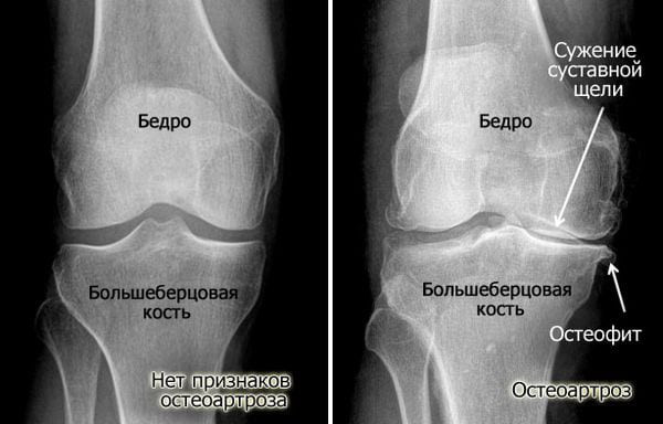 Артроз и остеоартроз. Чем отличается, разница