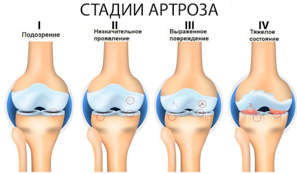 Артроз и остеоартроз. Чем отличается, разница