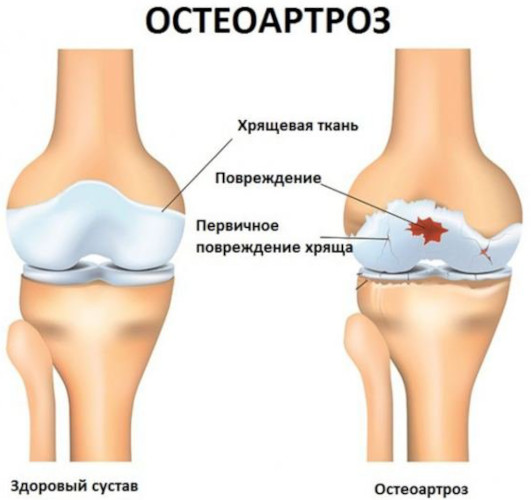 Артроз и остеоартроз. Чем отличается, разница