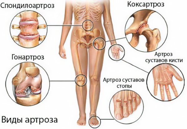 Артроз и остеоартроз. Чем отличается, разница