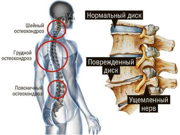 Боль в спине при вдохе: справа, сзади посередине, слева ниже лопатки