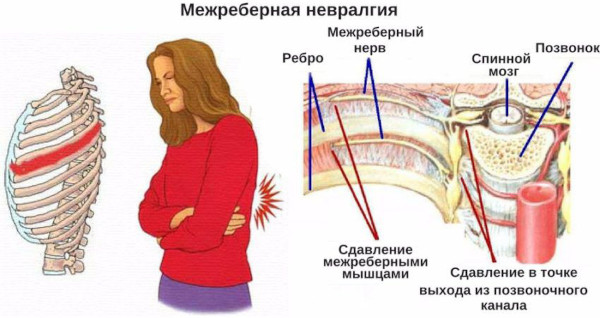 Боль в спине при вдохе: справа, сзади посередине, слева ниже лопатки