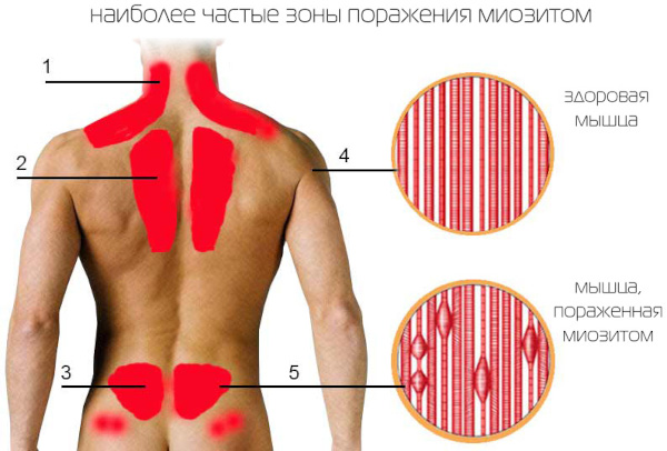 Боль в спине при вдохе: справа, сзади посередине, слева ниже лопатки