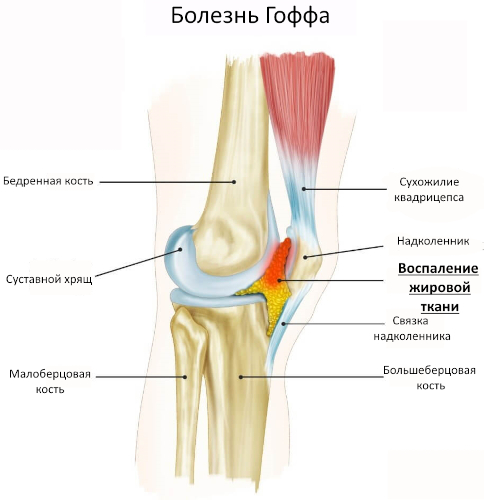 Болезнь Гоффа коленного сустава. Что это, лечение