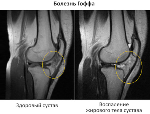 Болезнь Гоффа коленного сустава. Что это, лечение