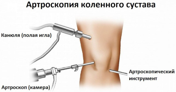 Болезнь Гоффа коленного сустава. Что это, лечение