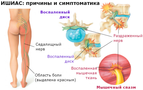 Болит копчик после родов при сидении и вставании. Что делать