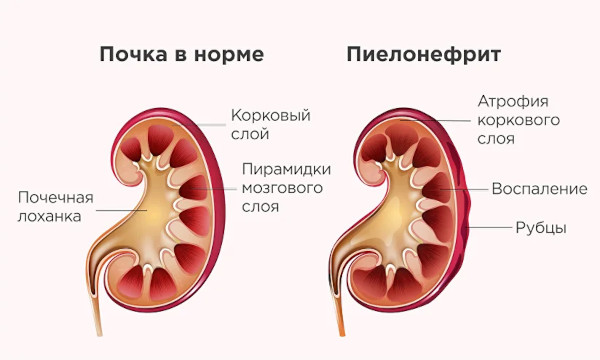 Лигатурный свищ после кесарева. Что это, фото, симптомы