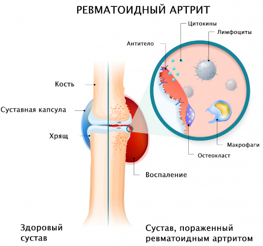 Диета при ревматоидном артрите суставов. Полезные и запрещенные продукты