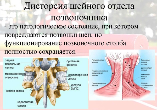 Дисторсия шейного отдела позвоночника. Что это такое, лечение