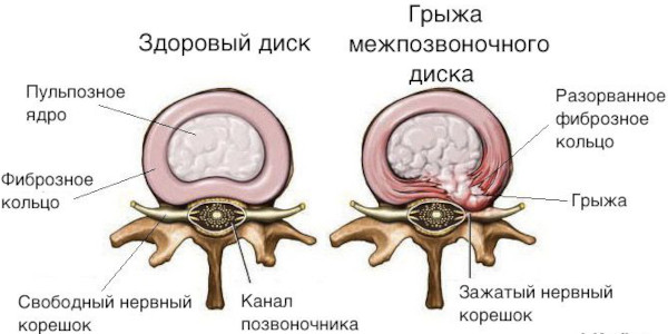 Фораминальный стеноз поясничного отдела позвоночника