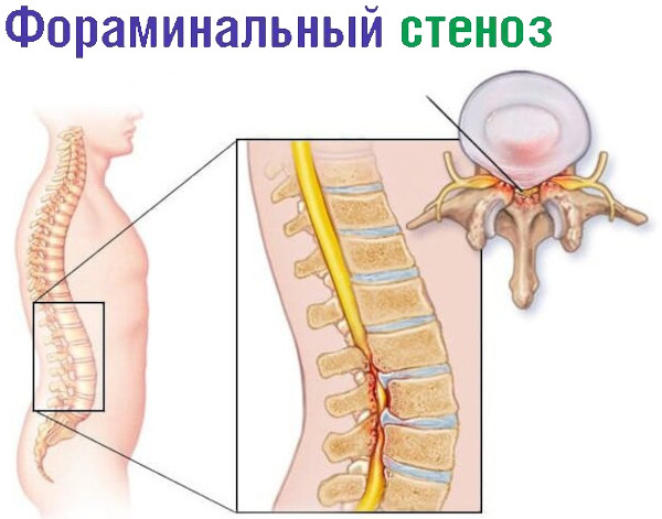 Фораминальный стеноз поясничного отдела позвоночника