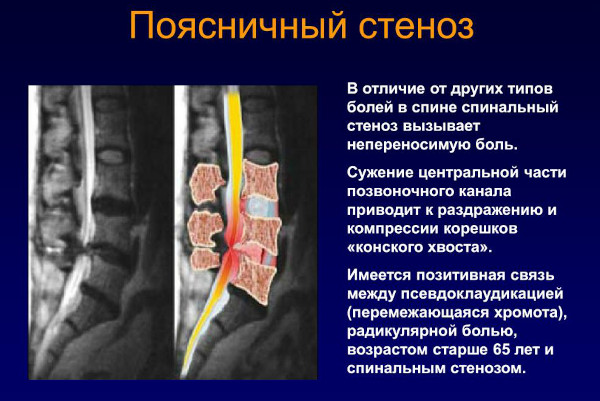 Фораминальный стеноз поясничного отдела позвоночника